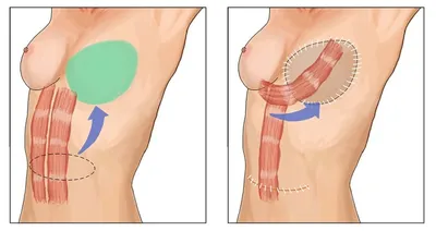 Пластика груди после удаления железы - Исамутдинова Г. М.