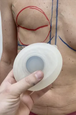 Операция по реконструкции груди в Саратове по доступной цене
