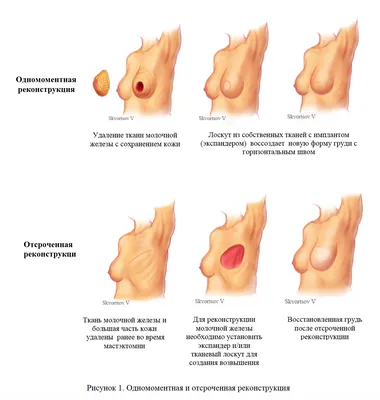 Томские онкологи применили новый метод восстановления груди после рака -  Российская газета