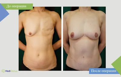 Реконструкция груди после мастэктомии, фото до и после | Олтерен-Эстетик