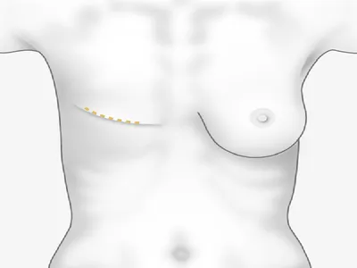 Процедура icoone для восстановления после мастэктомии при опухоли груди -  icoone