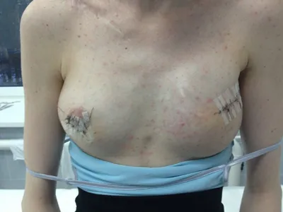 Реконструкция груди после мастэктомии, рака груди в Краснодаре - цены в  клинике Medeast