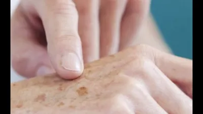 Как убрать пигментные возрастные пятна на руках? - клиника лазерной  косметологии в Москве