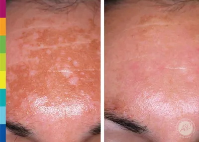 Почему появляется пигментация у женщин на лице - ответы косметолога Sesderma