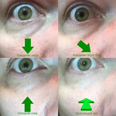 Как исправить особенность «впалых глаз»? | Современный взгляд с Давидом  Гришкяном на пластическую хирургию | Дзен