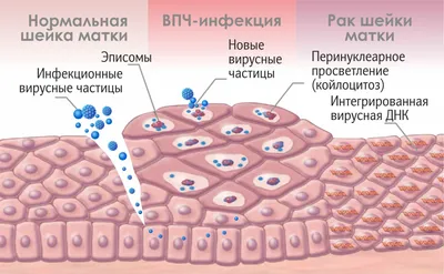 Удаление папиллом в интимной зоне