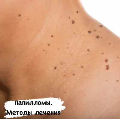 Опасность и способы лечения папиллом на теле | HappyDerm