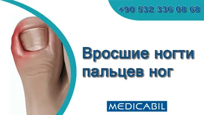 Лечить вросший ноготь в Мытищах запись по тел.84957240787