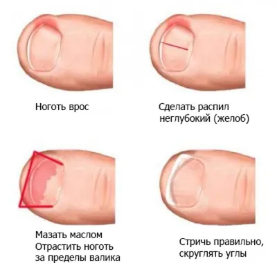 Что делать, если на ноге вросший ноготь? - Одесская Жизнь