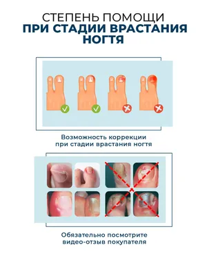 Екм От вросшего ногтя корректор -наклейки