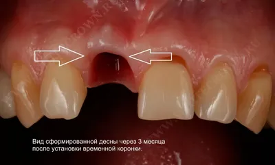 Пластмассовые коронки в разделе Новости ФЦ Ортос