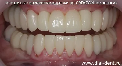 Нолатек Временные коронки SLA - фотополимер для дентал c доставкой