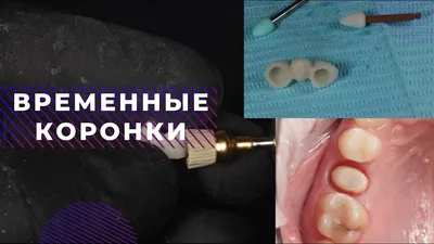 Временные коронки, набор 60 шт комплектующие и элементы зубных протезов |  \"Dental Group\".