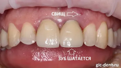 Имплантация и временное протезирование переднего зуба при периодонтите –  Немецкий имплантологический Центр, Москва