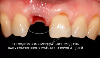 Временные коронки как важный этап имплантации - Немецкий имплантологический  центр