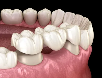 Имплантация и временное протезирование переднего зуба при периодонтите –  Немецкий имплантологический Центр, Москва