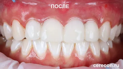 Что такое зубная коронка, и когда нужна установка временной коронки на зуб?