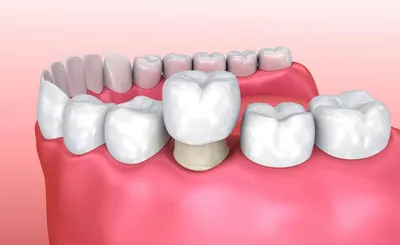 Коронки на передние зубы для устранения природных несовершенств