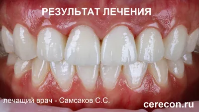 Какие коронки ставят на зубы: виды временных и постоянных коронок