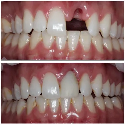 Восстановление передних зубов и создание улыбки - клиника Церекон | Москва