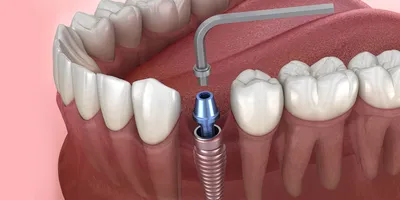 Циркониевые коронки на передние зубы - примеры работ стоматологии KANO