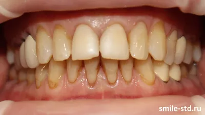 Имплантация Дентиум и установка временных коронок на передние зубы, фото до  и после Санкт-Петербург