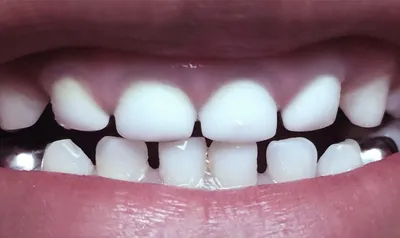 Что лучше на два передних верхних зуба - поставить коронки или 2 винира.  Пример реконструкции зубов с фото