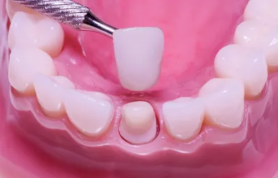 Зубными имплантами восстановить передние зубы