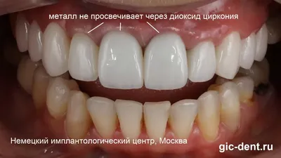 Временное протезирование с опорой на имплантаты - Авторская стоматология  CELEBRITY