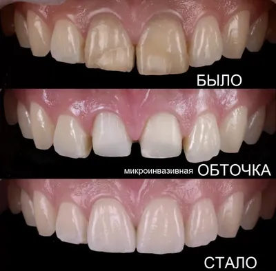 Протез на передние зубы: виды, цена протезирования | НоваДент