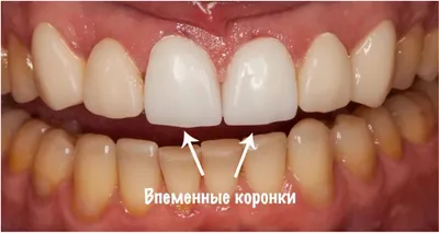 Временная коронка на имплант, цена на изготовление временных коронок на зуб  за день, сколько стоит, стоимость временной коронки на зуб в Москве