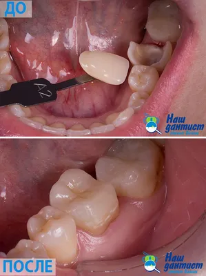 Имплантация Дентиум и установка временных коронок на передние зубы, фото до  и после Санкт-Петербург