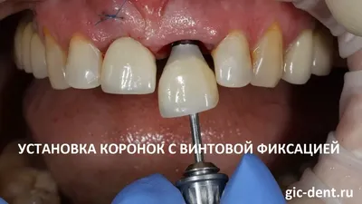 Зубные коронки, коронки на зубы, в Москве, цены, установка, от профессора