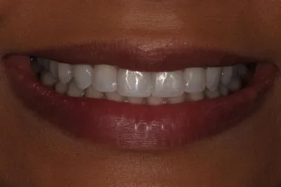 Коронки на штифте для протезирования зубов | СКАЙКЛИНИК