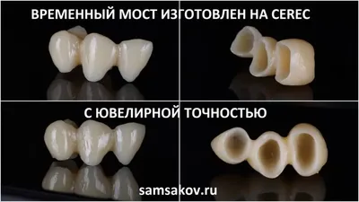 Передние зубы – удаление с имплантацией и протезированием за 1 день в ТОП1  клинике Москвы Немецкий Имплантологический Центр