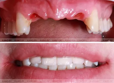 Установка коронки на зуб: циркониевые и керамические | Альянс  бьюти-ортопедов, Москва