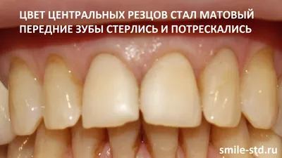Коронки на зубы – цена от 3 290 рублей в Нижнем Новгороде, виды коронок в  клинике Артдент