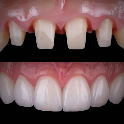 Кейс №7: металлокерамические коронки на импланты - примеры работ  стоматологии KANO