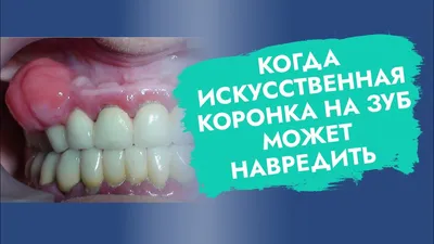 Видео. Культевые вкладки на передние зубы. | White Crown