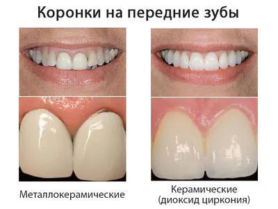 Сколько стоит вставить зуб в Москве под ключ, цена в Дантистофф