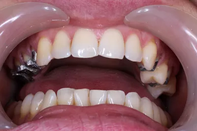Переделывание зубной коронки