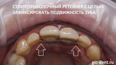 Временный бюгельный зубной протез после имплантации зубов