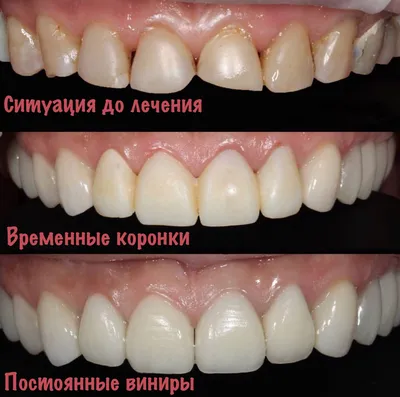 Реставрация и восстановление молочных зубов в Киеве: цена, отзывы