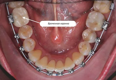 Молочные зубы у взрослых | Семейная стоматология