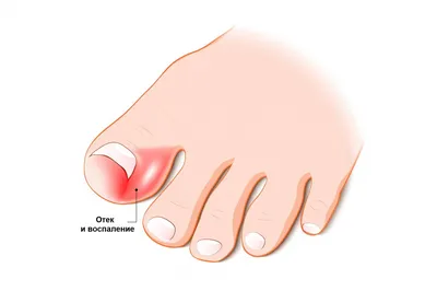 Вросший ноготь на ноге: что с этим делать - Клиника в Уручье
