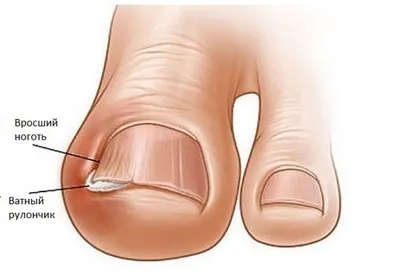 Ingrown toenails / Nail prone to ingrowth - YouTube