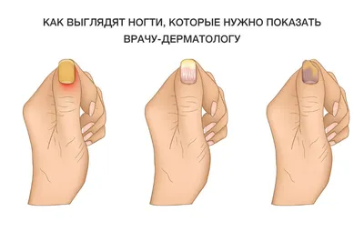 Ногтевая Клиника. Лечение вросшего ногтя в СПб от 1500 руб.