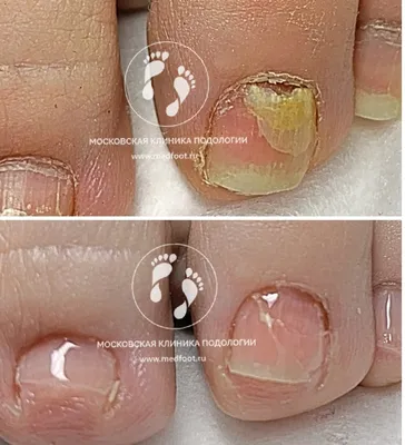 Удаление ногтевой пластины - «Как я пережила 5 операций с рецидивом после  каждой? Метод с 100% гарантией избавления от вросшего ногтя! » | отзывы