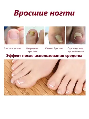 Лечение и профилактика ломких, хрупких ногтей рук и ног — Центр подологии  СТОПАМЕР