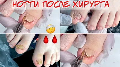 Irina Pestova - Сравните скорость восстановления ногтя после операции и  после работы подолога ⠀ У подростка на больших пальцах правой и левой ноги  был вросший ноготь. ⠀ Вначале в мягкие ткани впилась